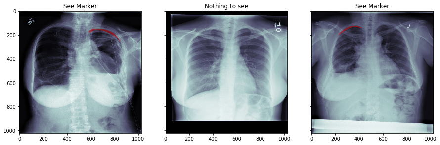 Pneumothorax Overlay. Credit https://www.kaggle.com/c/siim-acr-pneumothorax-segmentation/