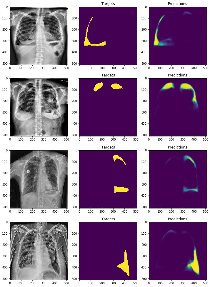 AI Diagnose Pneumothorax. Credit https://www.kaggle.com/c/siim-acr-pneumothorax-segmentation/