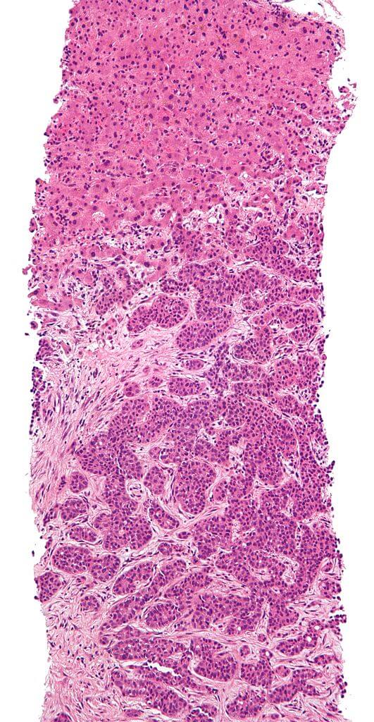 Metastasis proven by liver biopsy (tumor (adenocarcinoma)—lower two-thirds of image). H&E stain. Credit https://en.wikipedia.org/wiki/File:Adenocarcinoma_liver_metastasis.jpg