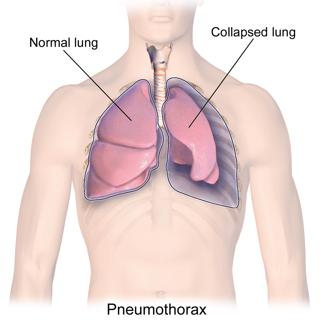 Illustration depicting a collapsed lung or pneumothorax. Credit https://en.wikipedia.org/wiki/File:Blausen_0742_Pneumothorax.png