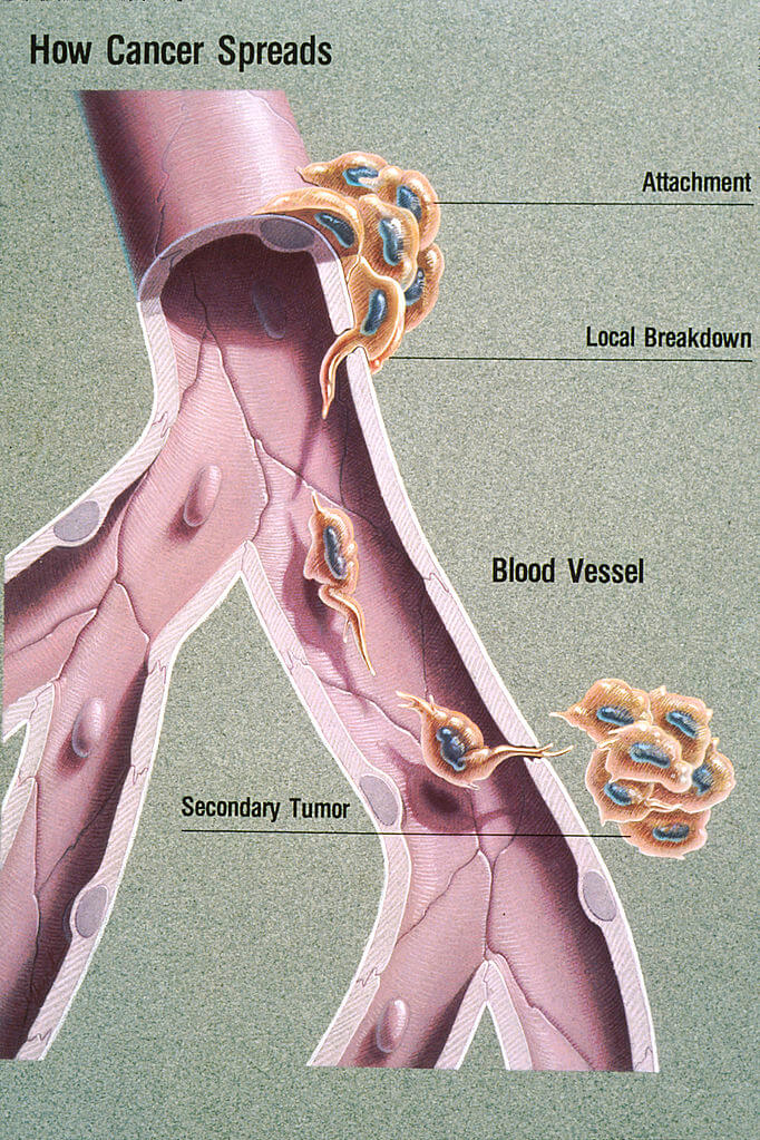 Illustration showing hematogenous metastasis. Credit https://en.wikipedia.org/wiki/File:Metastasis_illustration.jpg