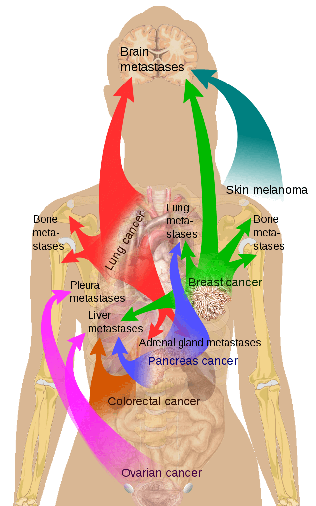 Metastasis ที่มักพบบ่อย. Credit https://en.wikipedia.org/wiki/File:Metastasis_sites_for_common_cancers.svg