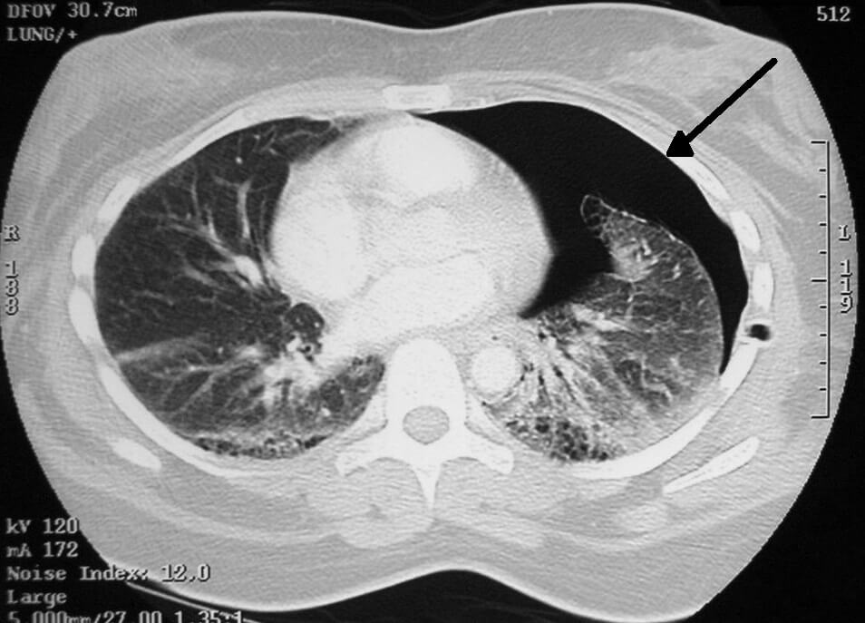 Right-sided pneumothorax (right side of image) on CT scan of the chest with chest tube in place. Credit https://en.wikipedia.org/wiki/File:Pneumothorax_CT.jpg