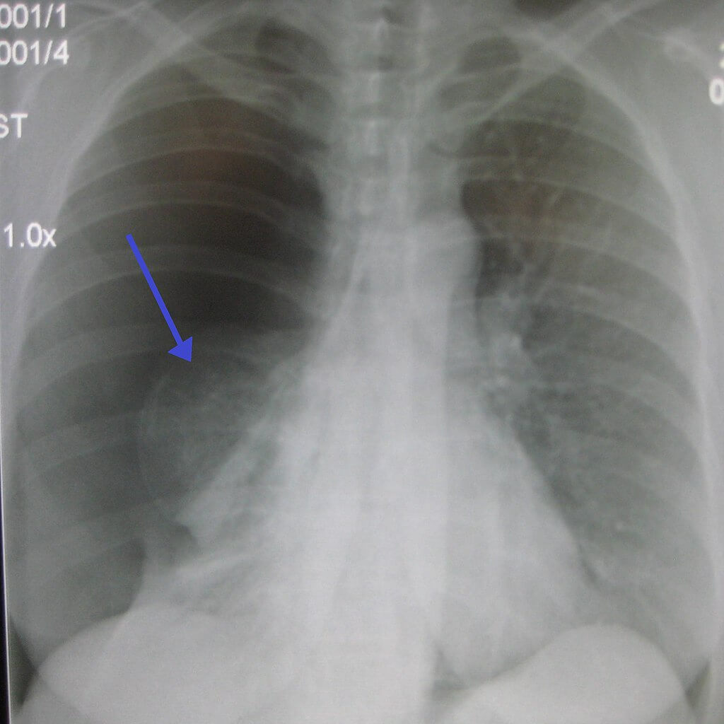 A large right-sided spontaneous pneumothorax. An arrow indicates the visible edge of the collapsed right lung. Credit https://en.wikipedia.org/wiki/File:Rt_sided_pneumoD.jpg