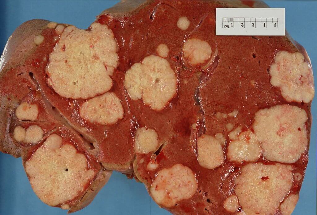 Cross section of a human liver, taken at autopsy examination, showing multiple large pale tumor deposits. The tumor is an adenocarcinoma derived from a primary lesion in the body of the pancreas. Credit https://en.wikipedia.org/wiki/File:Secondary_tumor_deposits_in_the_liver_from_a_primary_cancer_of_the_pancreas.jpg