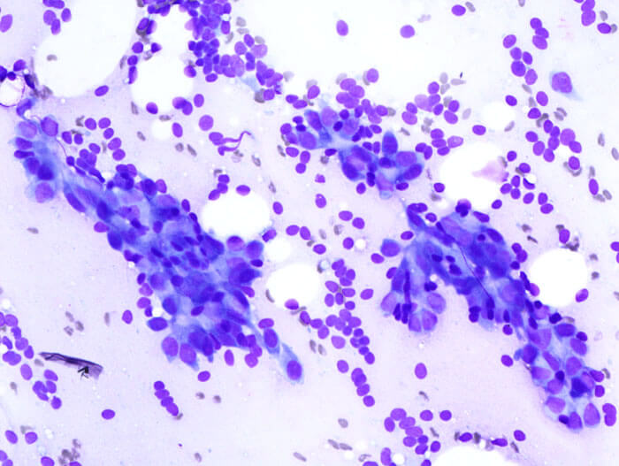 Breast fibroadenoma by FNAC stained with Diff-Quik. Credit https://commons.wikimedia.org/wiki/File:Breast_fibroadenoma_by_fine_needle_aspiration_(1)_DG_stain.jpg