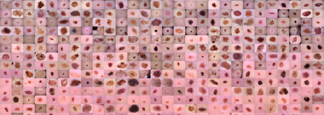 Skin Cancer MNIST: HAM10000 a large collection of multi-source dermatoscopic images of pigmented lesions. Credit https://www.kaggle.com/kmader/skin-cancer-mnist-ham10000