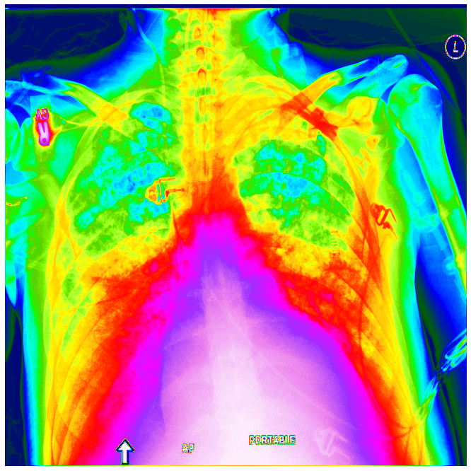 Visualization of DICOM X-Ray file Pneumothorax Patient in gist_ncar Colormap