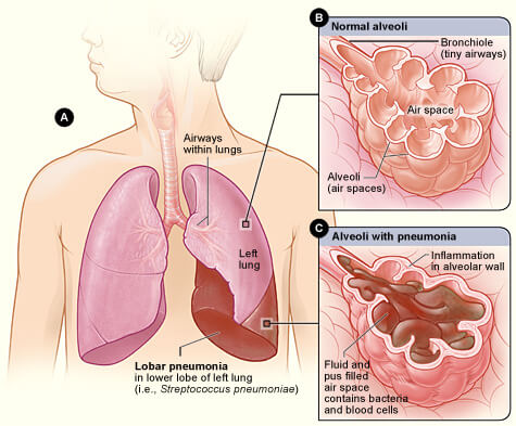 Figure A shows the location of the lungs and airways in the body. This figure also shows pneumonia affecting the lower lobe of the left lung. Figure B shows normal alveoli. Figure C shows infected alveoli. Credit https://commons.wikimedia.org/wiki/File:Lobar_pneumonia_illustrated.jpg