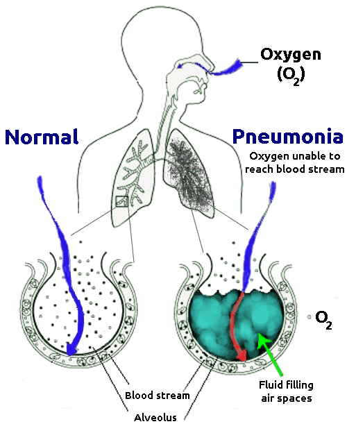 Pneumonia Oxygen unable to reach blood stream. Credit https://commons.wikimedia.org/wiki/File:New_Pneumonia_cartoon.png