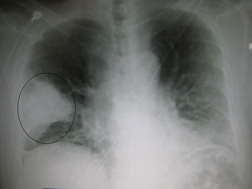 A black and white X-ray picture showing a triangle white area on the left side. A circle highlights the area. Credit https://en.wikipedia.org/wiki/Classification_of_pneumonia#/media/File:PneumonisWedge09.JPG