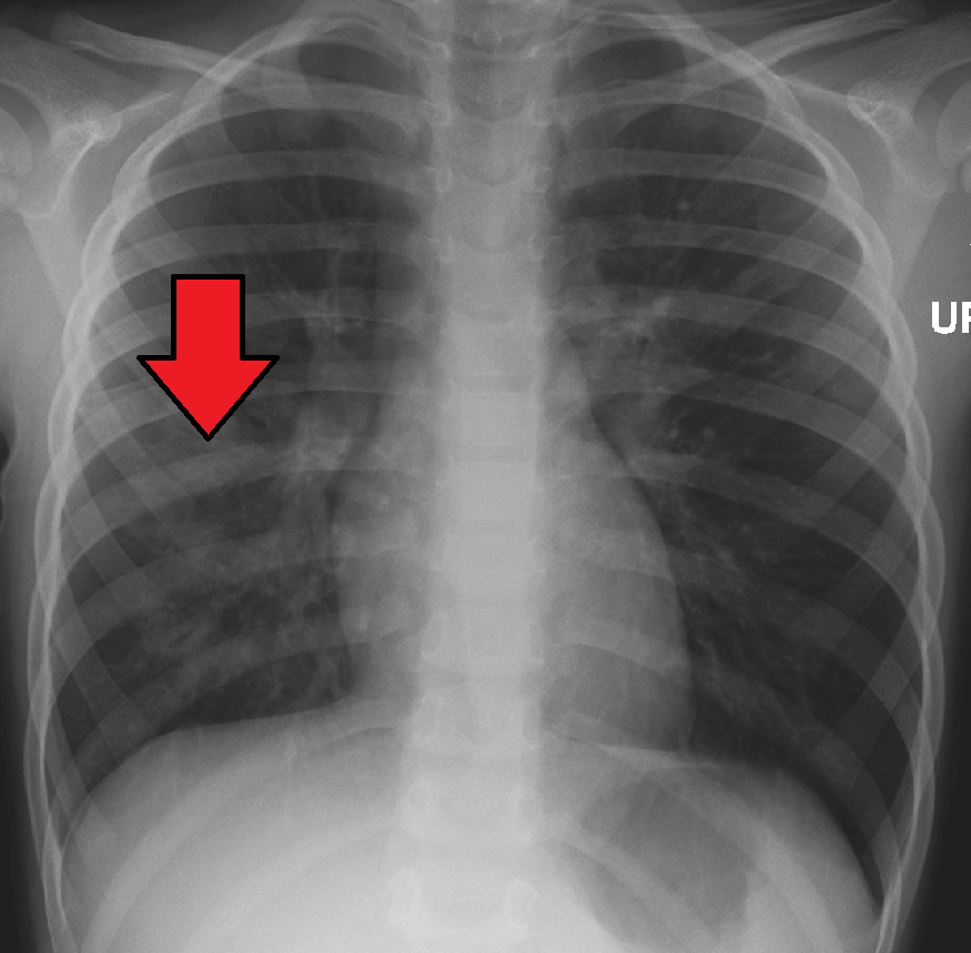 Right middle lobe pneumonia in a child Credit https://en.wikipedia.org/wiki/File:RtPneuKidMark.png