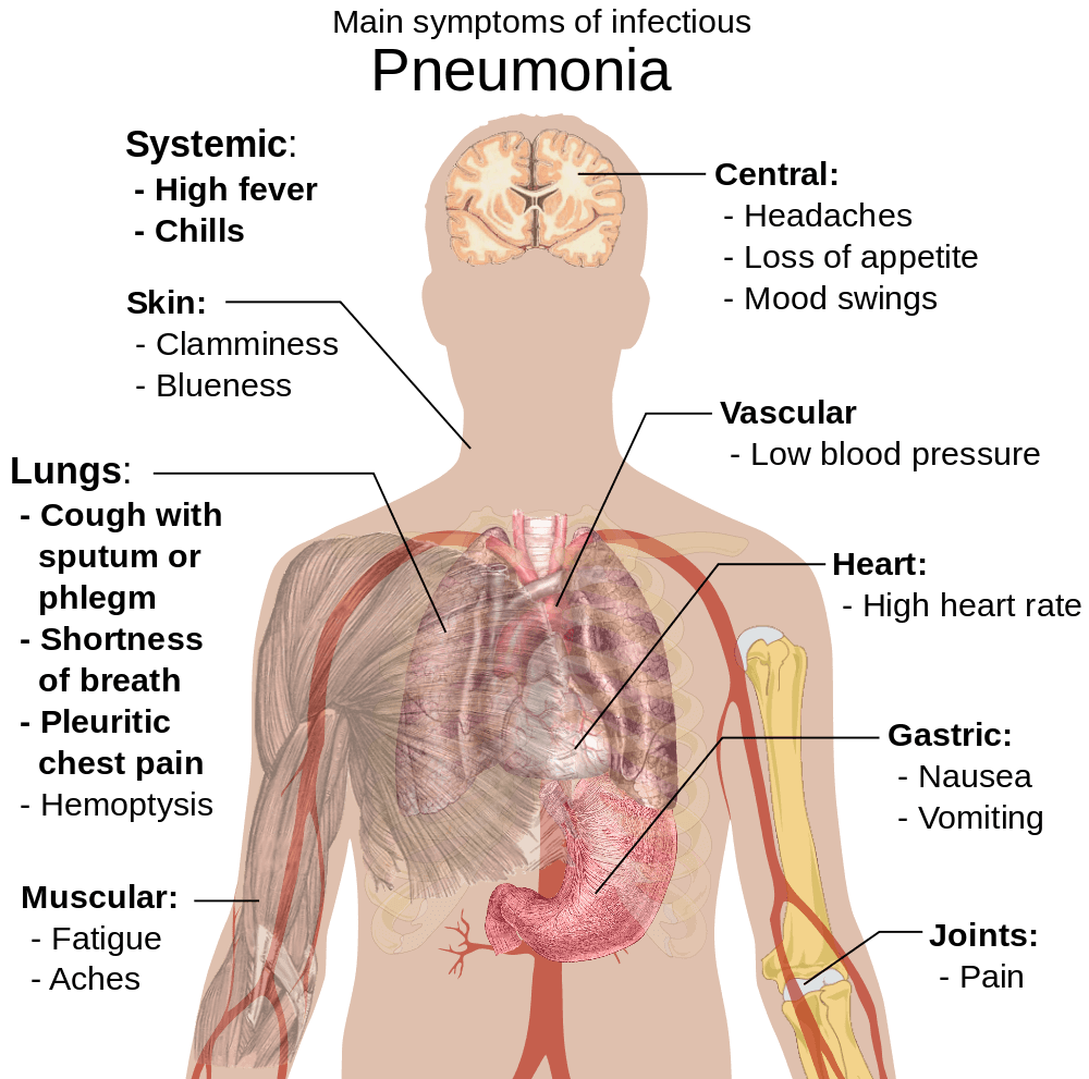 Main symptoms of infectious pneumonia. Credit https://commons.wikimedia.org/wiki/File:Symptoms_of_pneumonia.svg